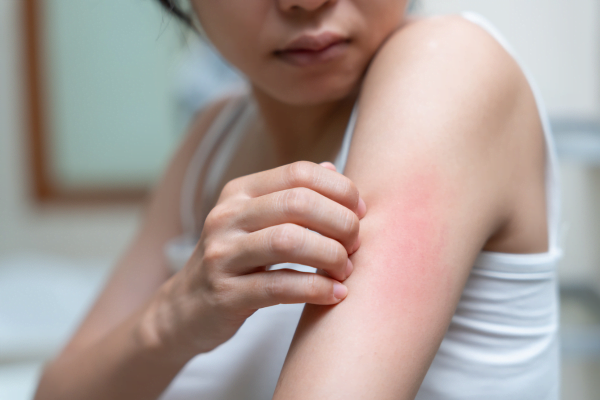 Diabetes and Skin Conditions: Understanding the Connection 3 diabetic dermopathy